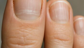 Ногти и дефицит витамина D: как распознать по признакам без гаданий